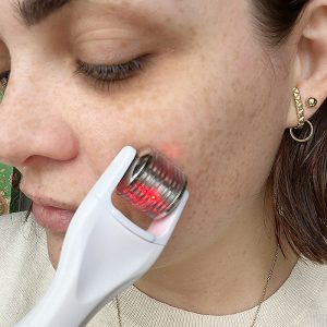 O microagulhamento liberado pra fazer em casa